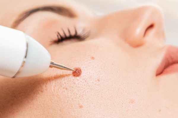 What actually happens during a CryoPen treatment Shepperton Green?