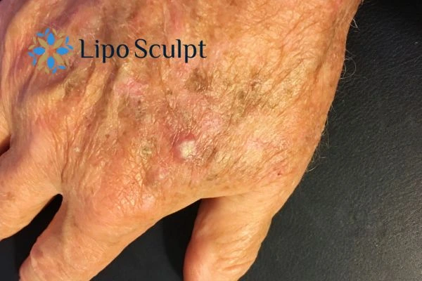 Learn about actinic keratosis, its causes, available treatment options and when to seek medical advice.