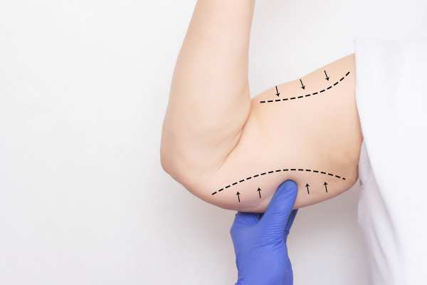 Arm toning treatment Shepperton Green from lipo Sculpt!