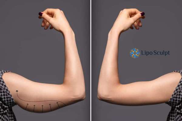 HIFU to reduce and tone sagging skin and fat on the arms from Lipo Sculpt Shepperton Green