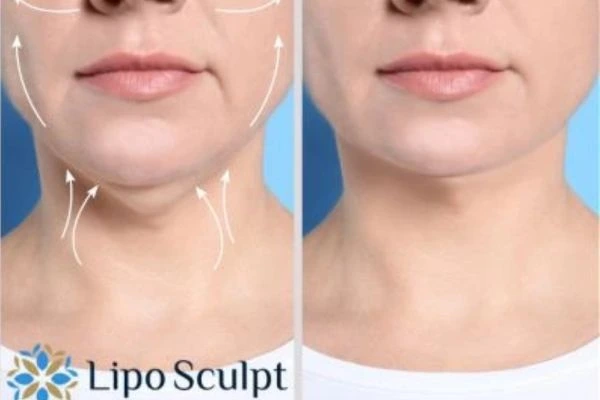 Book your Chin Reduction Treatment Shepperton Green today! Call Lipo Sculpt NOW!