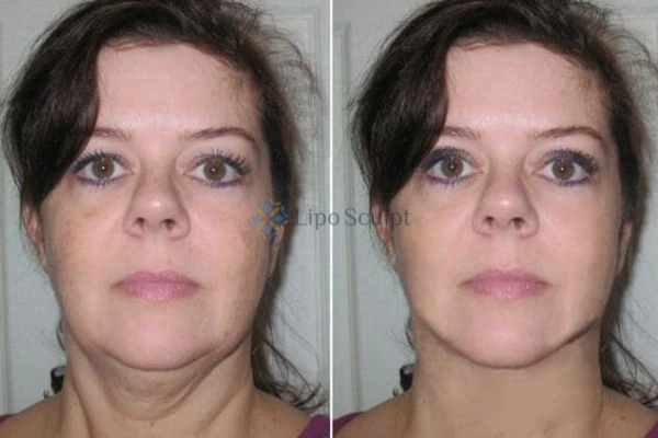 Chin Reduction Treatment Shepperton Green - Aqualyx treatment