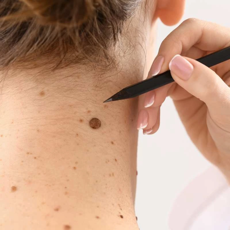 See our lesion removal prices Shepperton Green - call today for a free quote