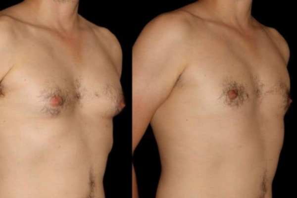 Before and After Cryolipolysis Fat Freezing Results Shepperton Green