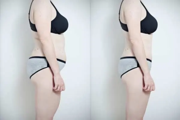 Before and After Cryolipolysis Fat Freezing Results Shepperton Green