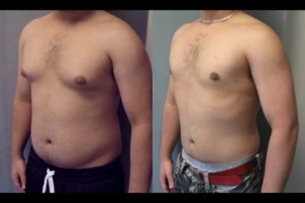 Before and After Cryolipolysis Fat Freezing Results Shepperton Green