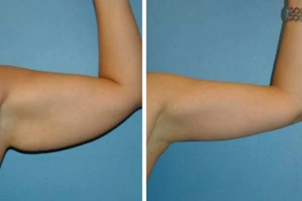 Before and After Cryolipolysis Fat Freezing Results Shepperton Green